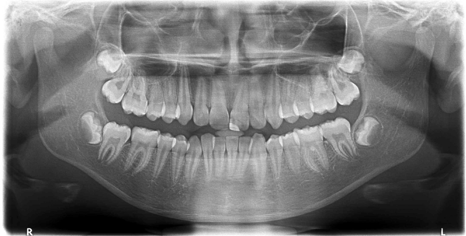 panoramic x ray presentation